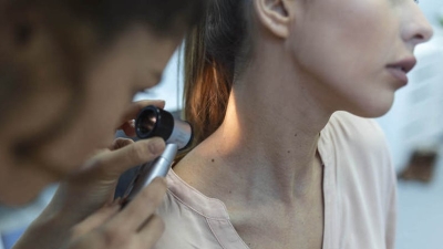 Melanoma